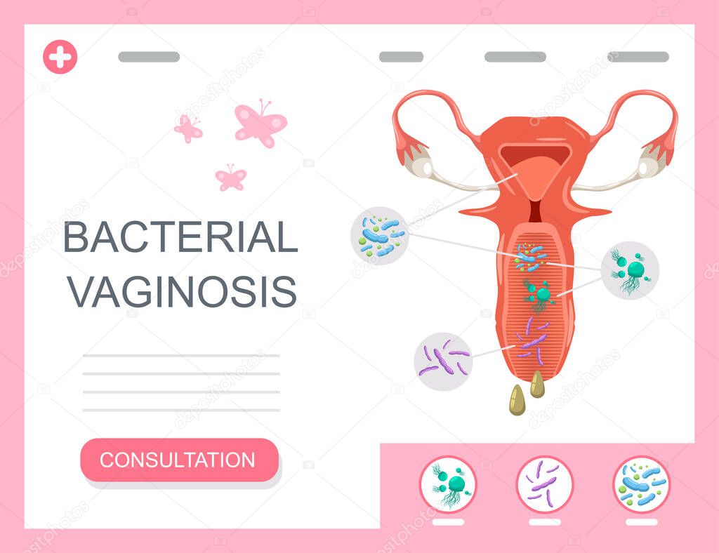 Bacterial vaginosis medical infographics with female reproductive organ with bacteria and microbes. Vector concept illustration.