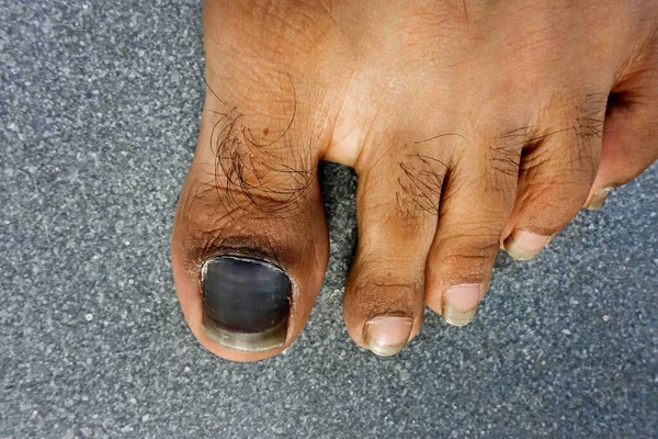 Крупный План Сгусток Крови Большим Ногтем Травмы Знайте Палец Бегуна — стоковое фото