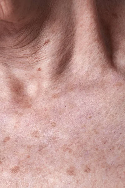 Alternde Weibliche Haut Mit Melasma Flecken — Stockfoto