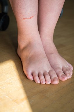 Çıplak Ayağın Topuğunda Sürtünme Topuğu. Ahşap Döşemede Cilt Aşınması.
