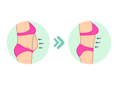 Göbek yağları. Diyet öncesi ve sonrası mide, fitness veya liposuction. Kadın göbeğinin vektör çizimi.