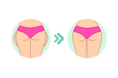 Dişi şişman kalçalar. Kadın poposu. Düz dizayn. Diyet öncesi ve sonrası, fitness veya liposuction. Kadın vektör illüstrasyonu yapıyor. Selülit tedavi programı, kilo kaybı.