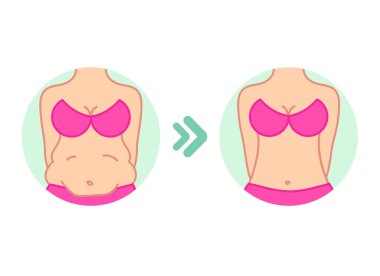 Göbek yağları. Diyet öncesi ve sonrası mide, fitness veya liposuction. Kadın göbeğinin vektör çizimi.