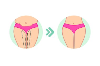 Dişi şişman kalçalar. Kadın poposu. Düz dizayn. Diyet öncesi ve sonrası, fitness veya liposuction. Kadın vektör illüstrasyonu yapıyor. Selülit tedavi programı, kilo kaybı.