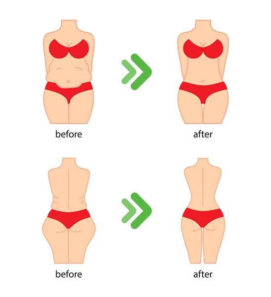 Liposuction hips, stomach. Removal of fat. Plastic surgery. Stock vector. — Stock Vector