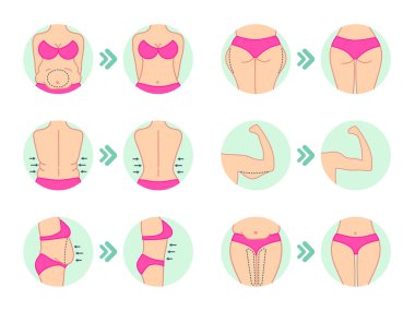 Yağ aldırma. Liposuction kalça, mide. Yağ ayıklama. Estetik ameliyat. Stok vektörü.