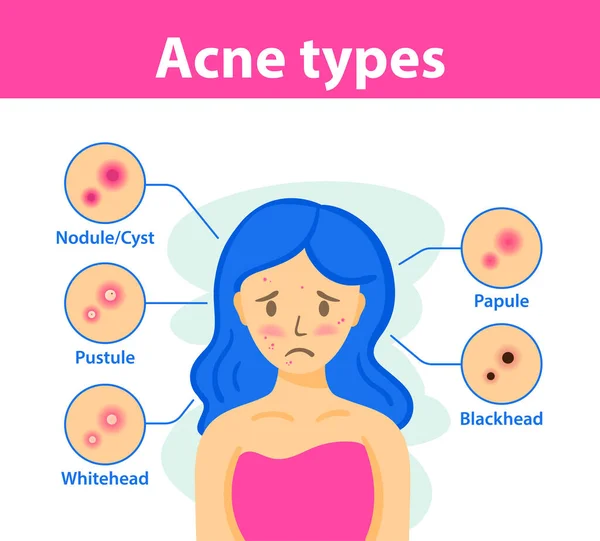 Akne-Arten, Krankheitsursachen, Behandlung. Infografik zu Akne. — Stockvektor