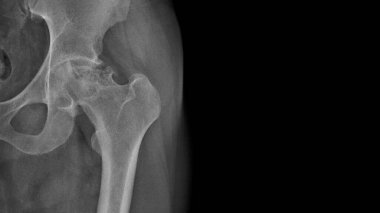 X-ray of a painful hip in a man with osteoarthritis of the left hip joint in the red area, very painful, difficult to walk, worn out joint, endoprosthetics. Surgical work required clipart
