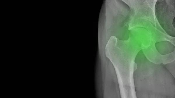 X-ray of a healthy hip in a man\'s left hip joint in the green area, walking easily, requires gymnastics and healthy nutrition