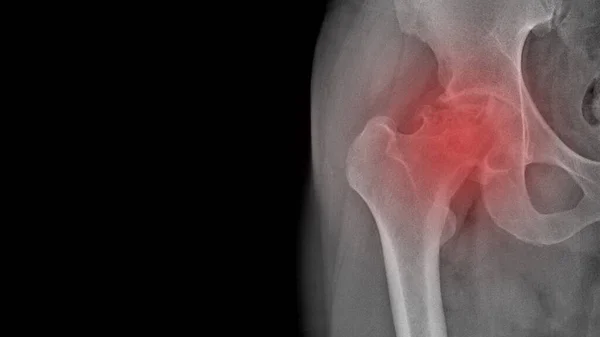 X-ray of a painful hip in a man with osteoarthritis of the left hip joint in the red area, very painful, difficult to walk, worn out joint, endoprosthetics. Surgical work required