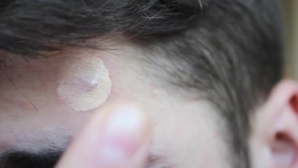 Problematisk Hud Hos Ung Man Med Mörkt Hår Acne Pannan — Stockvideo