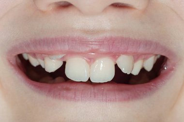 Diş büyütme kusuru olan bir çocuğun gülümsemesi.