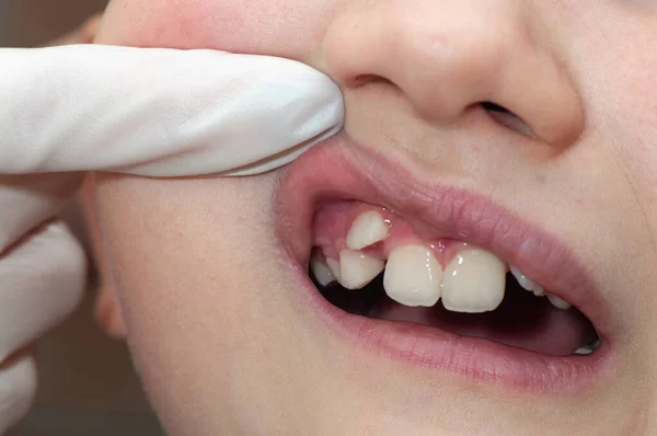 Orthodontist Die Mond Van Een Jongen Onderzoekt Tand Groeit Verkeerde — Stockfoto