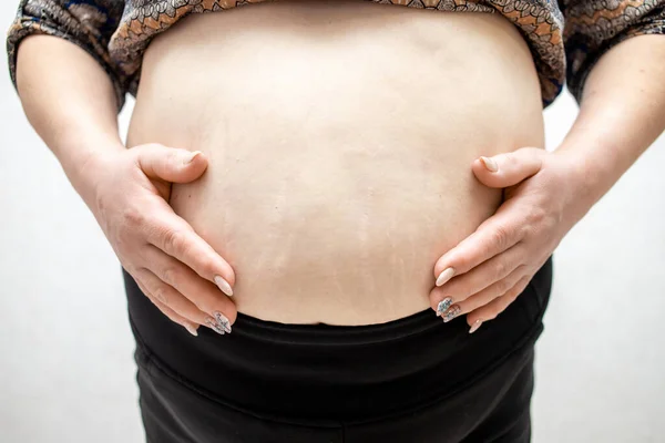 Uma mulher grávida. Uma mulher com uma barriga grande. Marcas de estiramento no abdómen. — Fotografia de Stock
