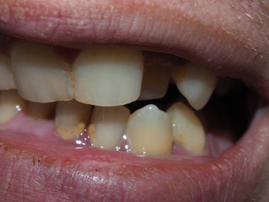 Hastanın hastalıklı dişler.  