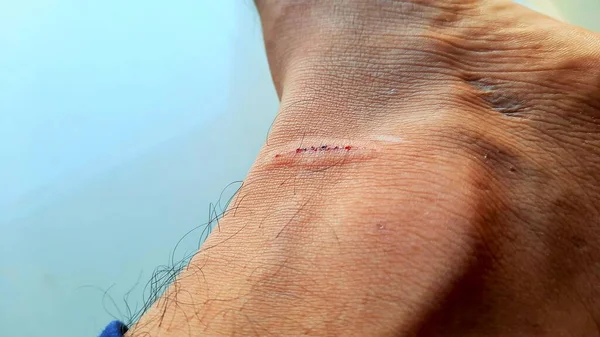 Gros Plan Une Petite Coupure Blessure Sur Peau Jambe — Photo