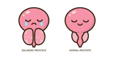 Cartoon benign and prostate vector illustration. Icon character of male urology inflammation disease. Flat design for diagram, medical journal article. Prostatitis, enlarged,obstruction,hypertrophy clipart