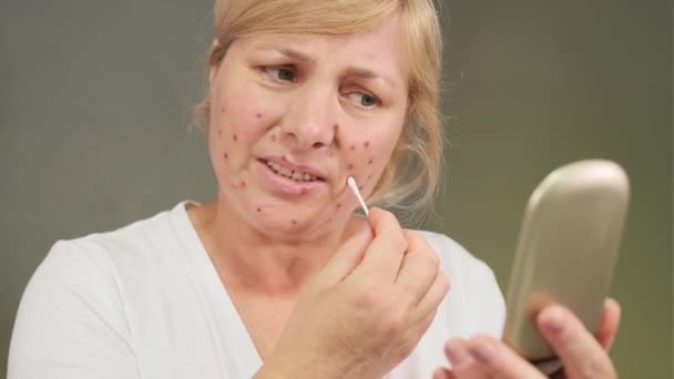 La donna di mezza età non può guardarsi allo specchio senza dolore e irritazione sul viso, si prende cura del suo viso per rimuovere i punti acne usando batuffoli di cotone.. — Video Stock