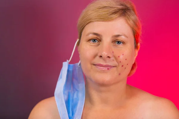 A imagem de perto da mulher idosa com o cabelo puxado para trás ter acne depois de usar a máscara médica há muito tempo em pandemia. — Fotografia de Stock