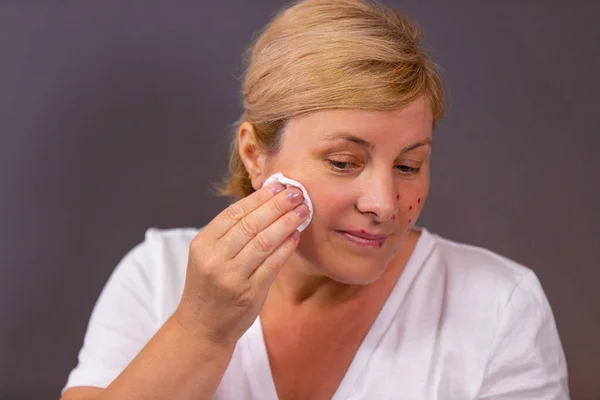 Uma mulher com pele problemática com acne, poderia se livrar da acne em uma bochecha usando disco de algodão com remédio limpando-o. — Fotografia de Stock