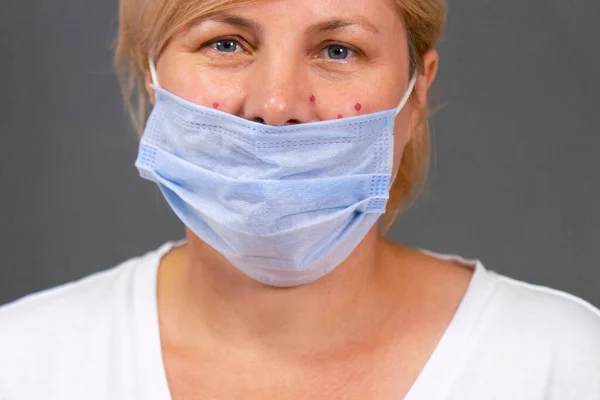 Närbild foto av en blond kvinna i en medicinsk ansiktsmask med akne problem efter att ha burit den engångsmask en lång tid. — Stockfoto
