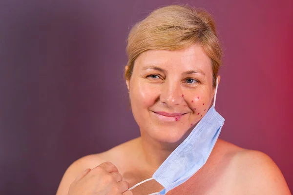 Feche a foto de uma mulher loira sorridente após procedimentos cosméticos para remover a acne em uma bochecha no salão de beleza no tempo pandêmico. — Fotografia de Stock