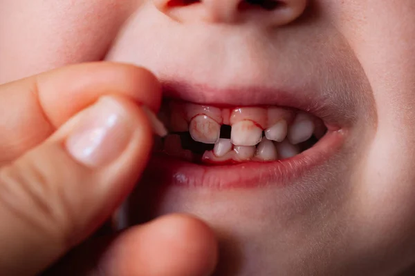 close-up blood on the teeth and in the mouth from a wound from a fallen baby tooth on the lower jaw and the doctors hand holding the removed tooth