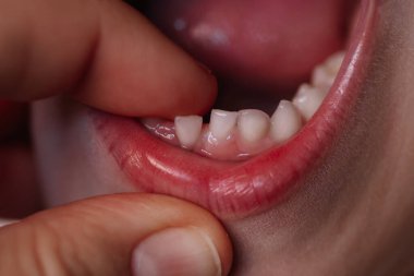 Küçük kızların ağzı ve bebek dişi sendeliyor, anne kızlarının ön dişlerini eliyle kontrol ediyor.