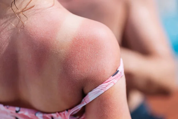 De rode rug van een meisje met een zonnebrand en witte lijnen van een badpak met een hotelzwembad op de achtergrond — Stockfoto