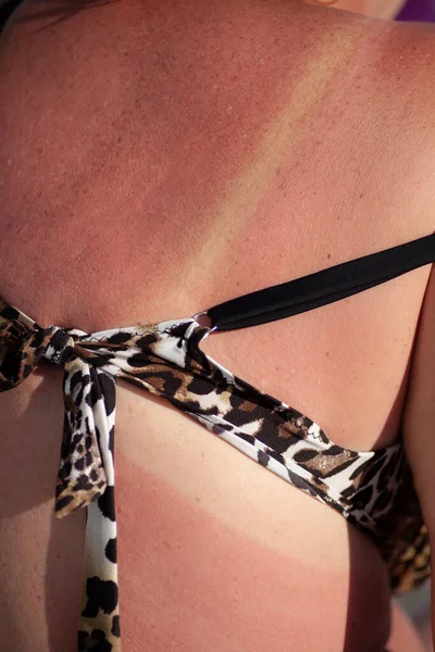 De rode rug van een volwassen vrouw met een zonnebrand en witte strepen van een zwembroek — Stockfoto