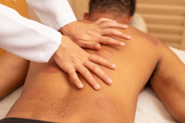 Birkaç vakum kabı izi olan bir hastanın sırtına masaj yapan terapist..