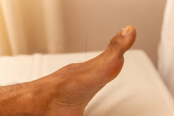 Detail Acupuncture Needle Patient Foot — Stock Photo, Image