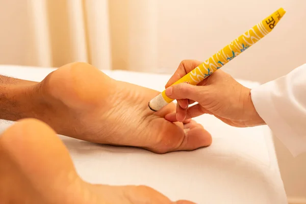 Terapeuta Tratando Paciente Com Moxibustion — Fotografia de Stock