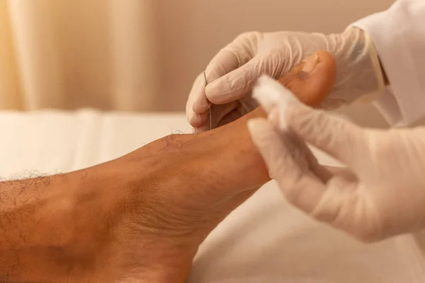 Manos Del Terapeuta Con Guantes Que Ponen Aguja Acupuntura Pie — Foto de Stock