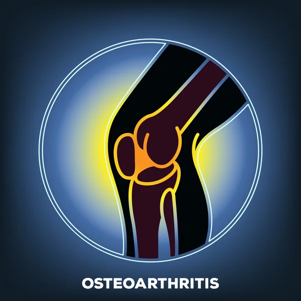 Osteoartrite — Vetor de Stock