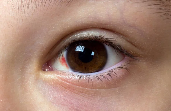 Κοντινό Πλάνο Δύο Ερεθισμένων Κόκκινων Ματιών Αίματος — Φωτογραφία Αρχείου