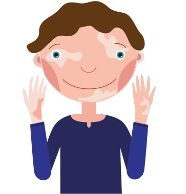 Beyaz arka planda gülümseyen vitiligo adam.