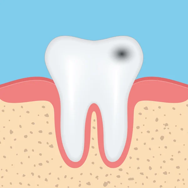 Menschlicher Zahn mit Karies — Stockvektor