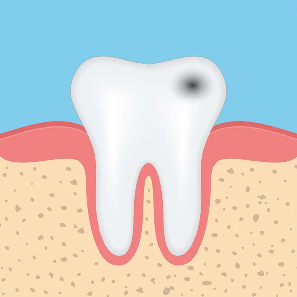 Diente humano con caries — Vector de stock