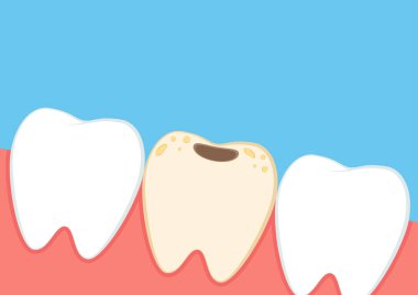 Diş karikatürü vektörü. Diş ekipmanı vektörü. Tatar artışı yaygın bir dişçidir. Diş boşluğu.