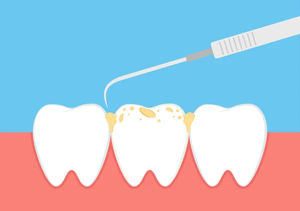 Tänder Tecknad Vektor Tandläkarutrustningens Vektor Tartar Uppbyggd Vanliga Dentala Tandhålan — Stock vektor