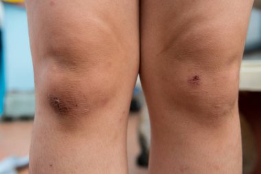 Yaralı bir çocuğun dizi.