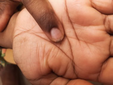 İnsanoğlunun elinde sivrisineği tuttuğu ve elinin üstünde oturduğu yakın plan.