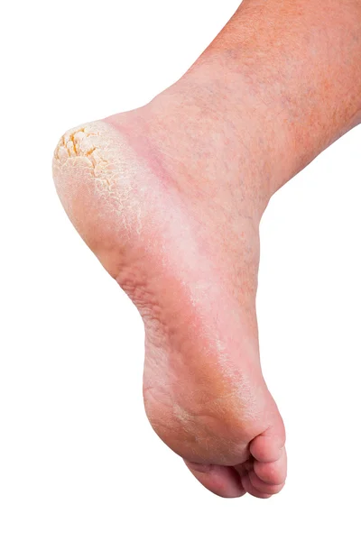  Beyaz arka plan üzerinde izole kırık topuk