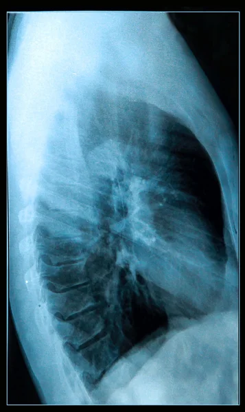 Hrudníku x-ray obraz — Stock fotografie