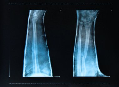 Arm fracture seen on X -ray clipart