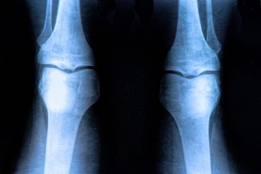 Knee X-ray