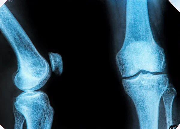 Knee X-ray — Stock Photo, Image