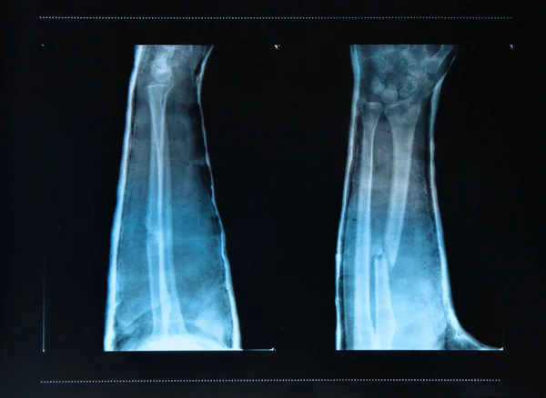 Paže zlomeniny vidět na X - ray — Stock fotografie