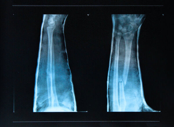 Arm fracture seen on X -ray